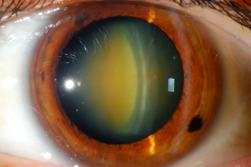 የዓይን ሞራ ግርዶሽ (Cataracts)