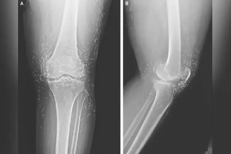 Doctors Uncover Hundreds of Gold Threads in Woman's Knees